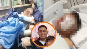 JOVEN QUE SUFRIÓ GRAVES LESIONES POR EXPLOSIVO EN EL MERCADO; SU ESTADO ES RESERVADO
