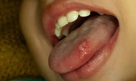 SEDES ALERTA SOBRE 17 CASOS DE HERPANGINA EN COLEGIOS DE POTOSÍ Y REFUERZA PREVENCIÓN